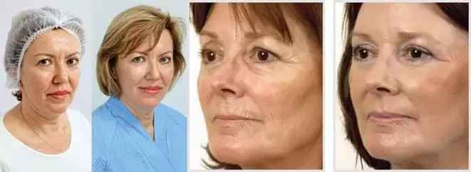 El resultado del rejuvenecimiento de la piel del rostro con láser es la reducción de las arrugas