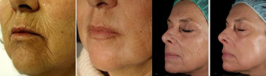 Piel del rostro antes y después del procedimiento de rejuvenecimiento con láser. 